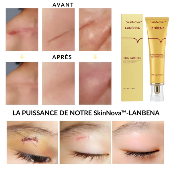 SkinNova™-Lanbena – Gel Réparateur pour Cicatrices, Vergetures et Marques d'Acné – Image 7