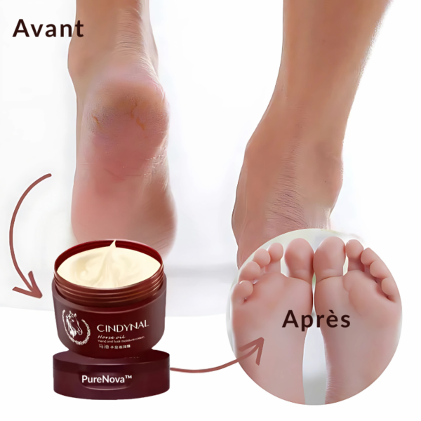 PureNova™-Cindynal – La Crème Réparatrice Intense pour Mains & Pieds Sévèrement Abîmés – Image 5