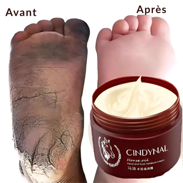 PureNova™-Cindynal – La Crème Réparatrice Intense pour Mains & Pieds Sévèrement Abîmés – Image 9