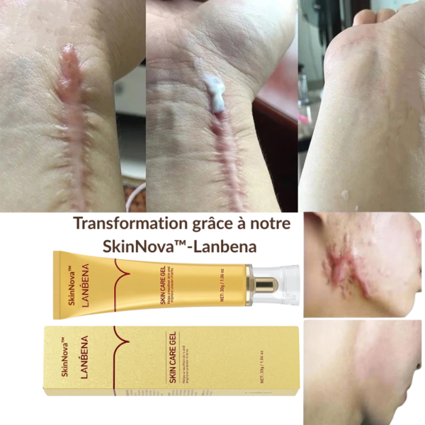 SkinNova™-Lanbena – Gel Réparateur pour Cicatrices, Vergetures et Marques d'Acné – Image 3