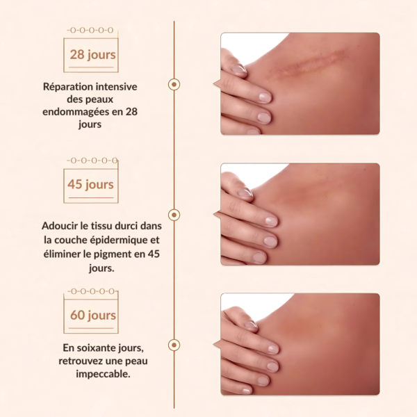 SkinNova™-Lanbena – Gel Réparateur pour Cicatrices, Vergetures et Marques d'Acné – Image 4