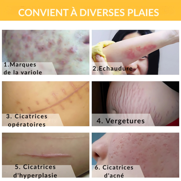 SkinNova™-Lanbena – Gel Réparateur pour Cicatrices, Vergetures et Marques d'Acné – Image 2
